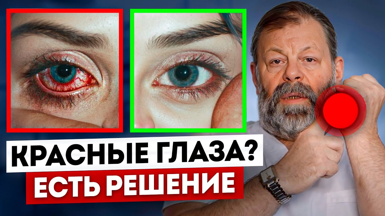 Красные глазаI Почему краснеют глаза? Покраснел 1 глаз, сосуды в глазах - что делать. Узнай причины