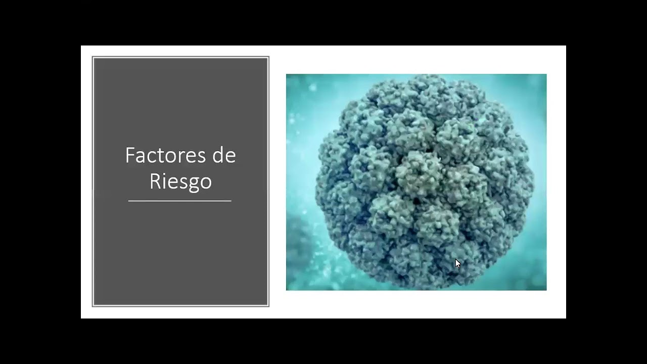 Leucoencefalopatía Multifocal Progresiva