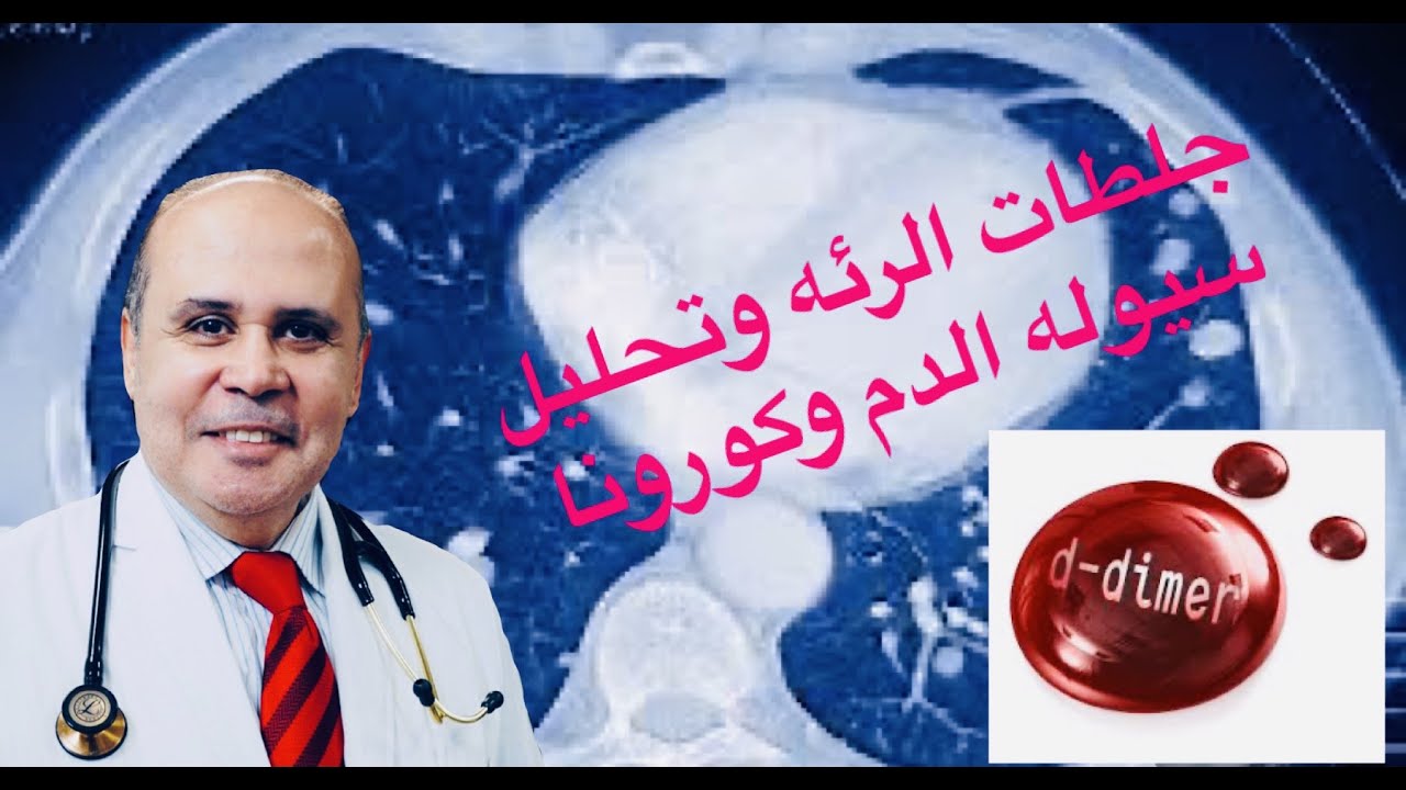 ارتفاع حالات الوفيات لمرضي كورونا..جلطه الرئه واهميه تحليل تجلط الدم