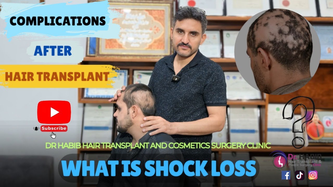 Complecations after Hair Transplant😨 What is Shockloss🤔 | Dr. Habib explain 💯