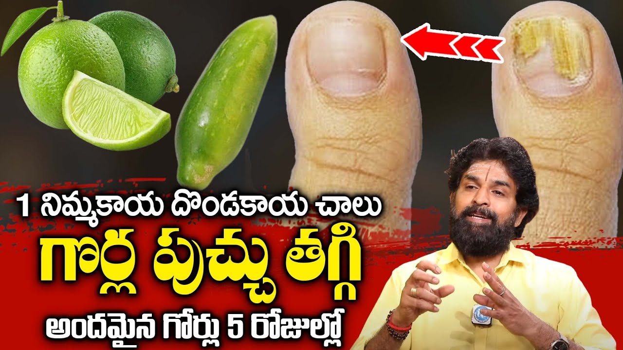 పుచ్చిపోయినా గొర్లకు, గోరుచుట్టు కు మాయం చేసే చిట్కా ..! || Goru Chuttu Home Remedy || Vikramaditya
