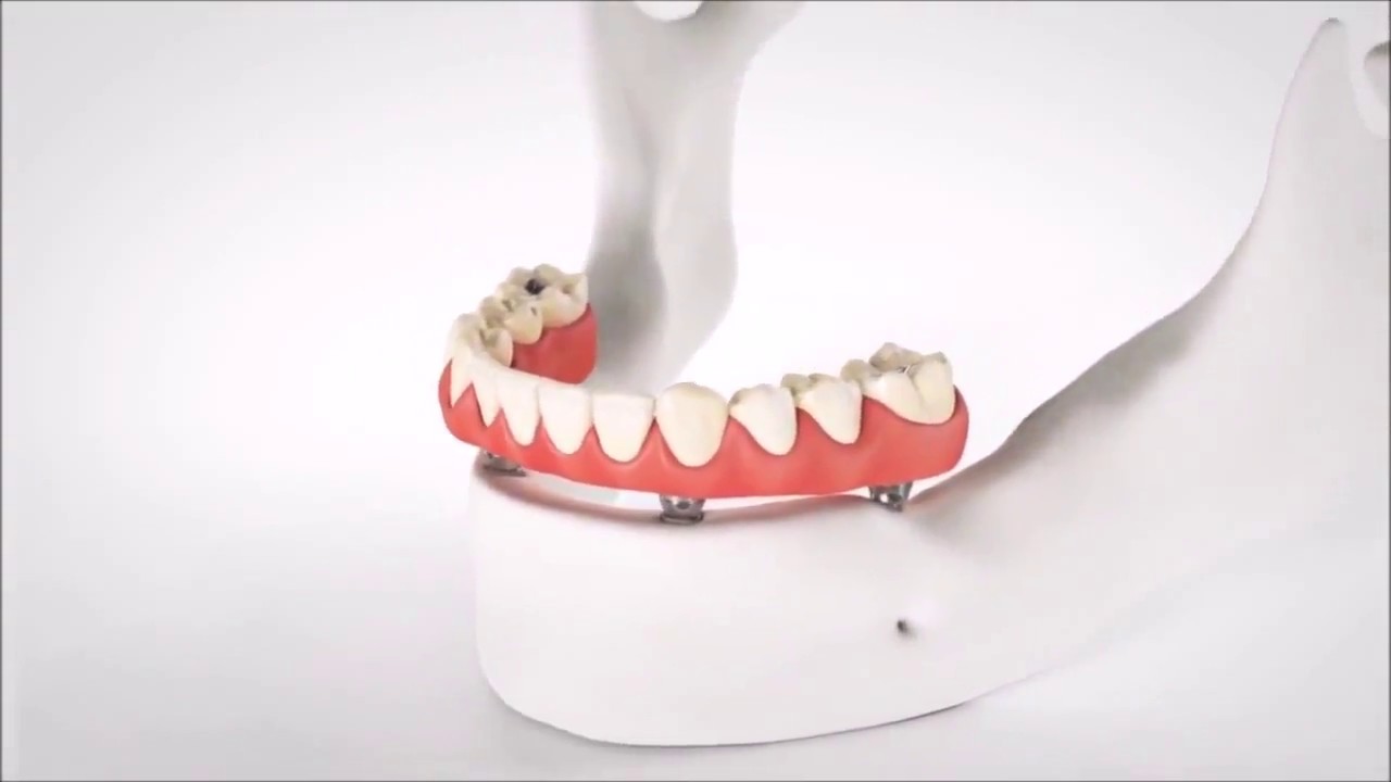 Coventry Dental Implants, Dentists Show Best Same Day Full Whole Mouth Teeth Implants