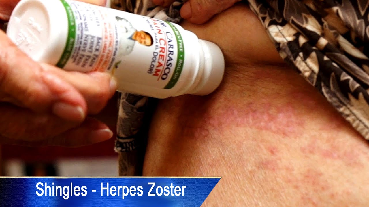 Monday Medical: Could Shingles be effecting your life?