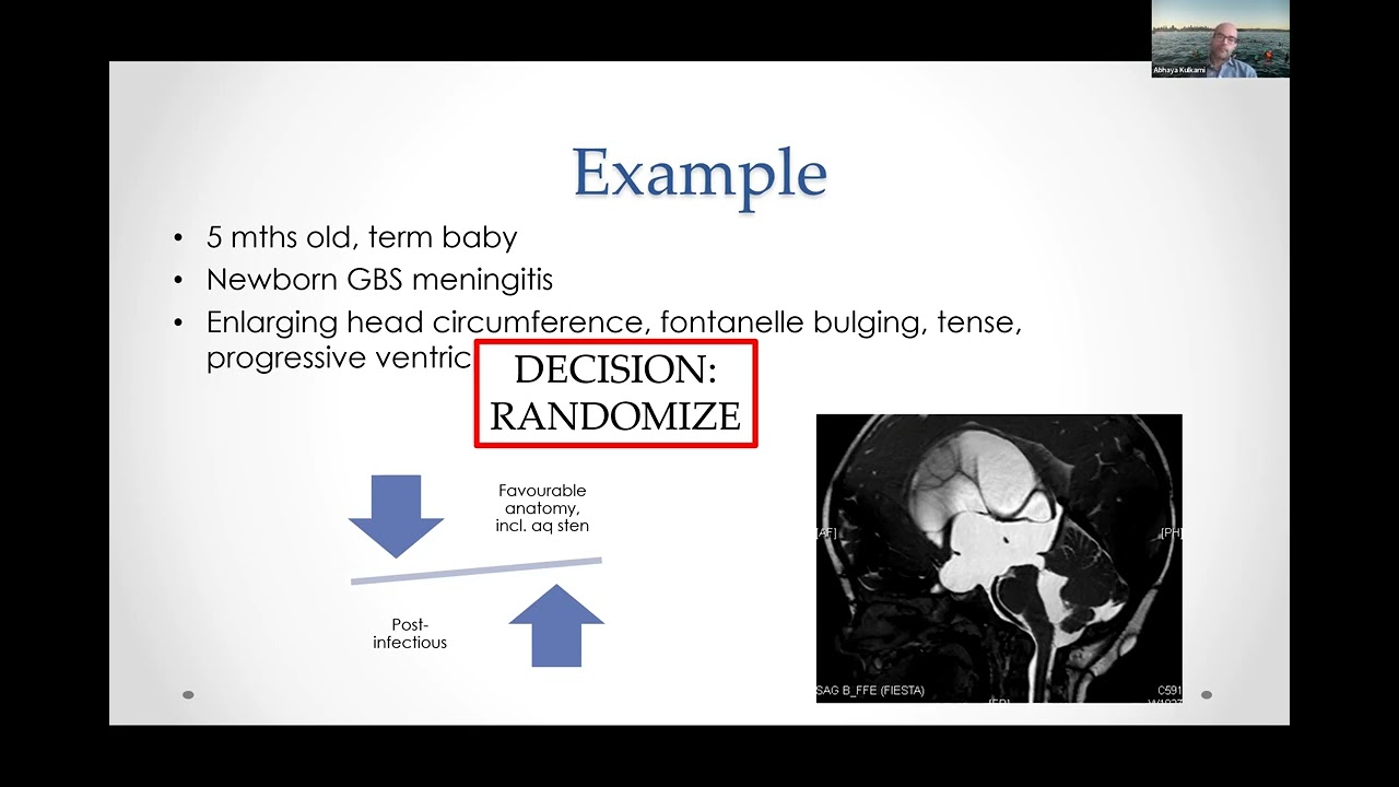 AANS Fellowship Lecture- Challenges in Hydrocephalus Management