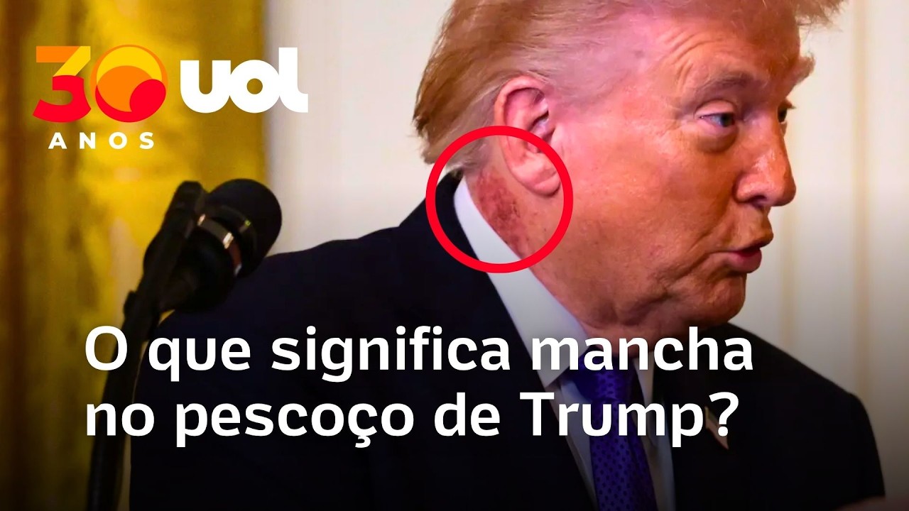 Médico explica o que causou a mancha vermelha no pescoço de Trump