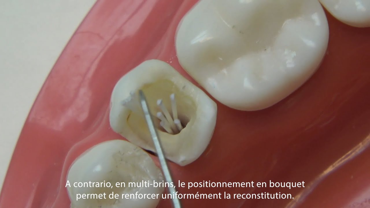 Procédure du système multi-tenons Biolight Drill-Free