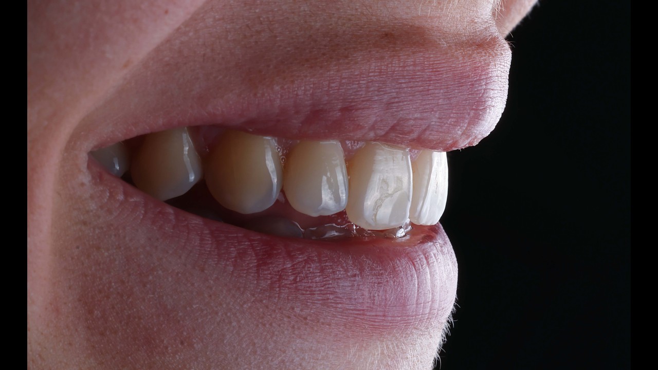 Canon RF100 Macro Lens Review for Dental Photography