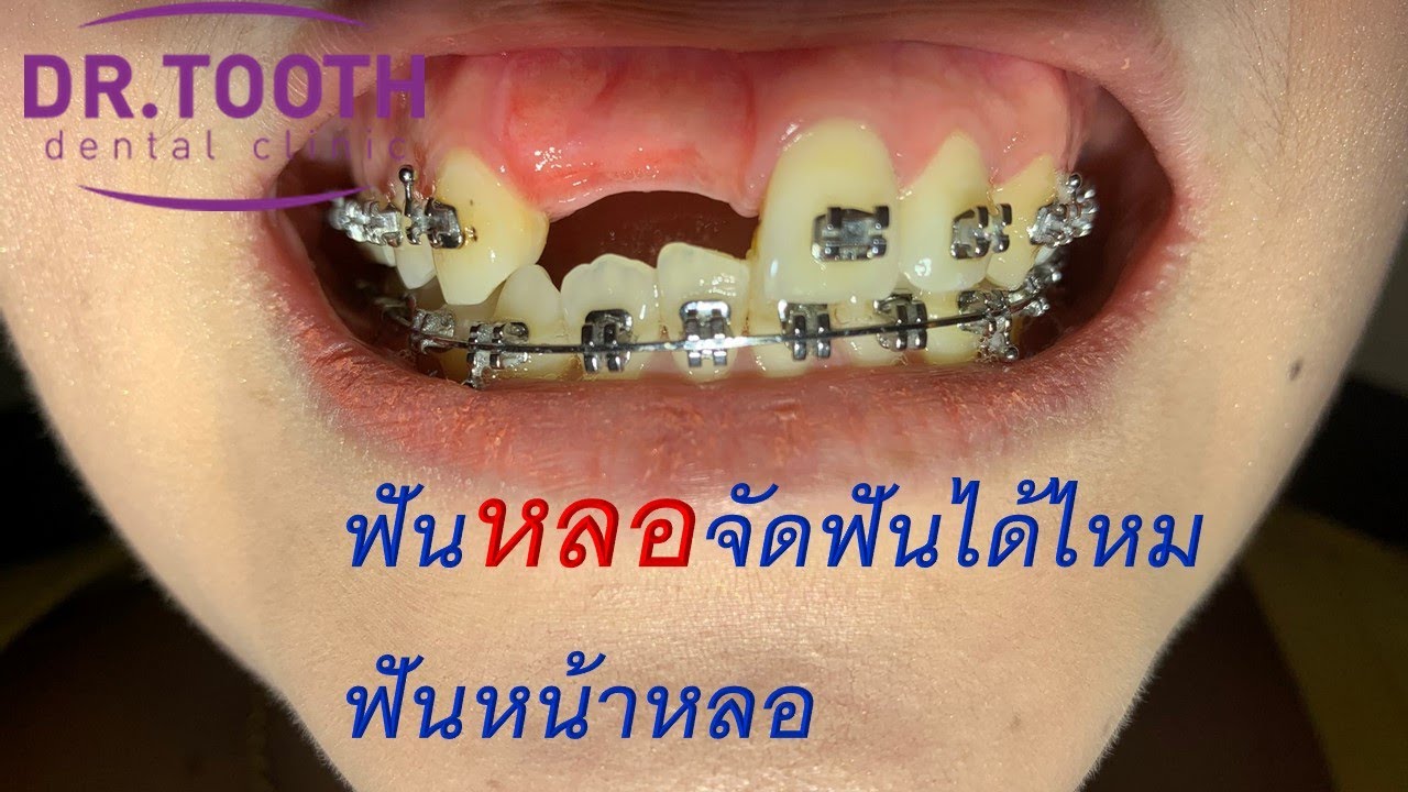 ฟันหลอจัดฟันได้มั้ย,ฟันหน้าหลอแล้วจะจัดฟันกันยังไง EP.1 #จัดฟันที่ไหนดี #จัดฟัน #จัดฟันครั้งแรก 