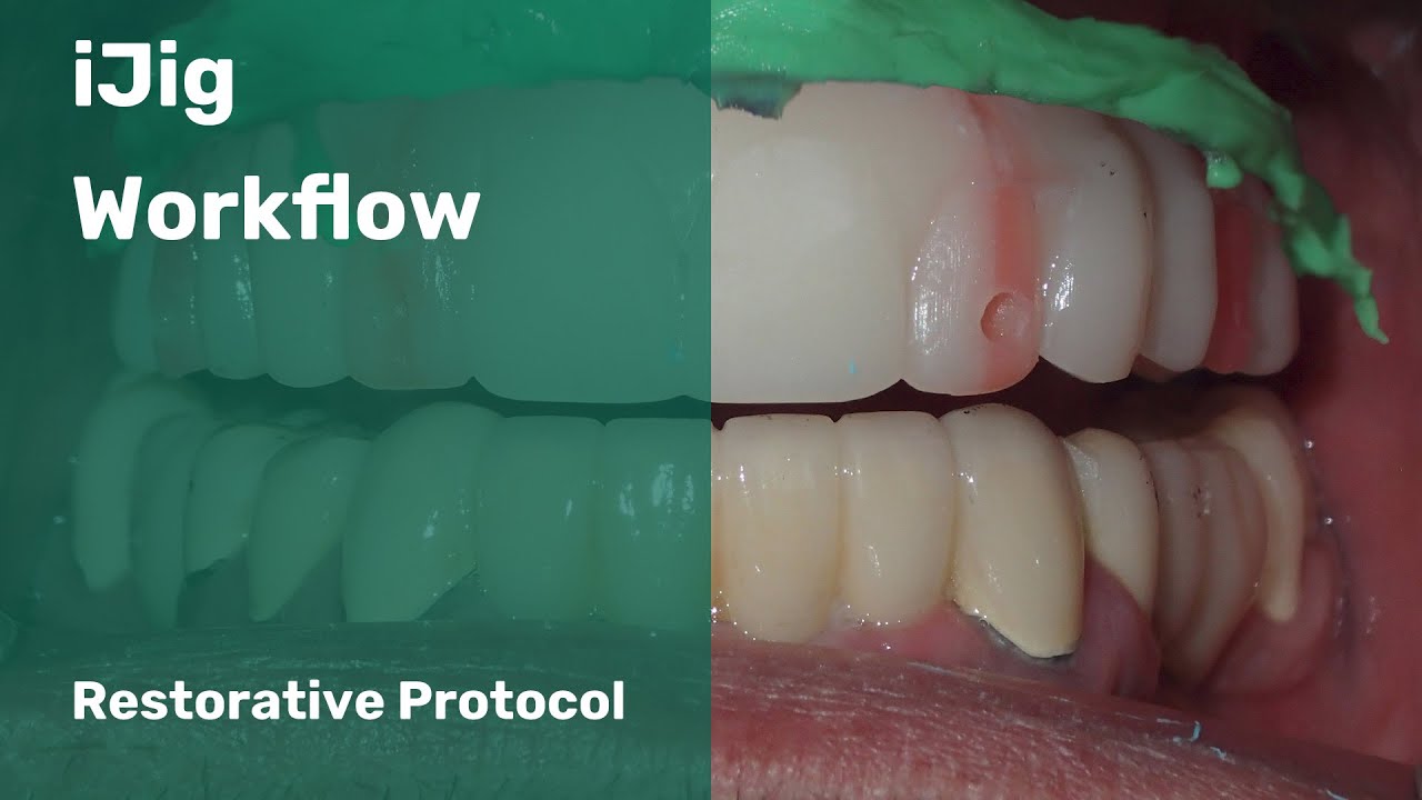 iJig Restorative Protocol