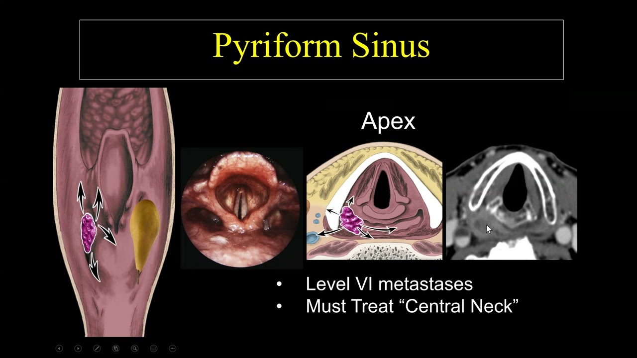 Suresh Mukherji  Imaging of the Hypopharynx