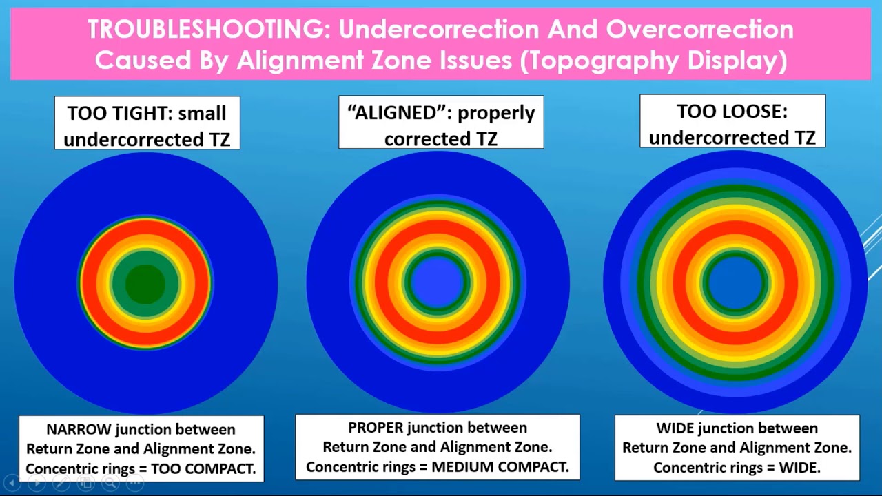 Part 2 of 2 : Troubleshooting A Wave Custom Ortho-K Lens