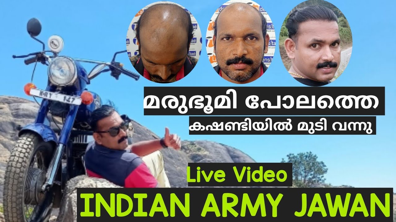 വെറും 3300 Grafts കൊണ്ട് 7Grade കഷണ്ടിയിൽ ഒരു മായാജാലം|വീണ്ടും അത്ഭുതം കാട്ടി Dr Jadhao|💪സല്യൂട്ട്