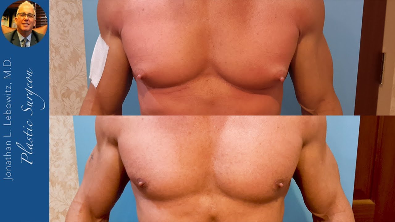 Before & After BIG Steroid Induced Gynecomastia Gland Removal By Dr. Lebowitz Long Island New York