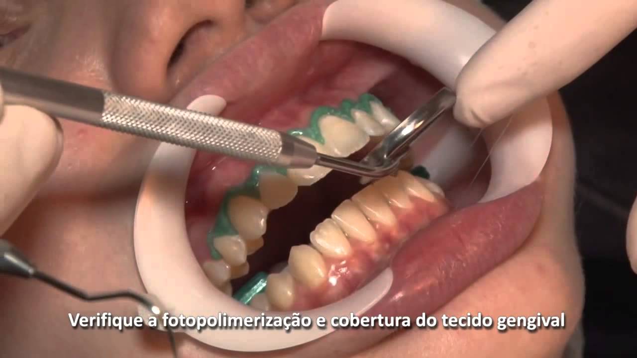 Whiteness HP Blue - FGM l Dental Speed