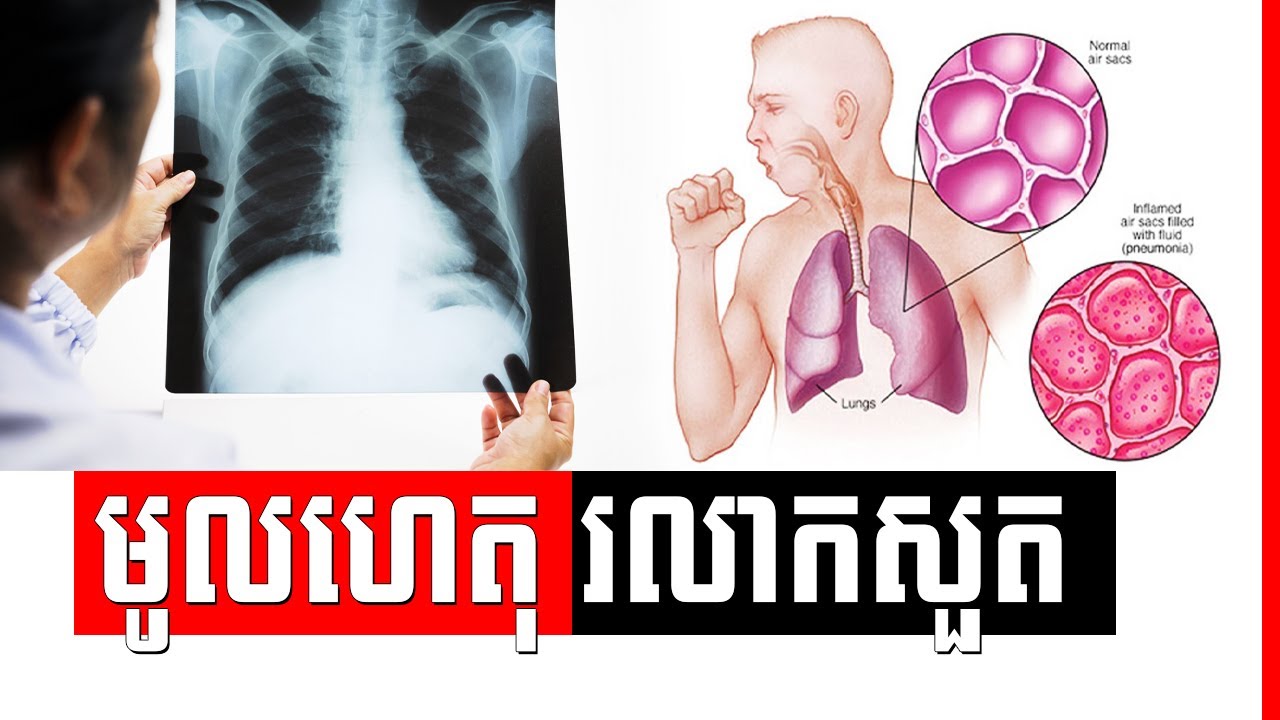 ​ជំងឺរលាក​សួត៖ មូលហេតុបង្ក និង វិធីការពារ , prevention of pneumonia