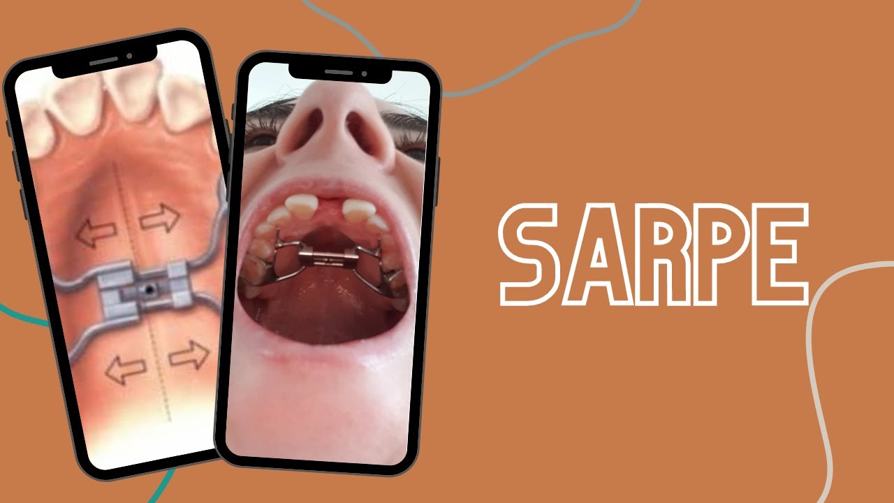 SARPE, jaw surgery #shorts