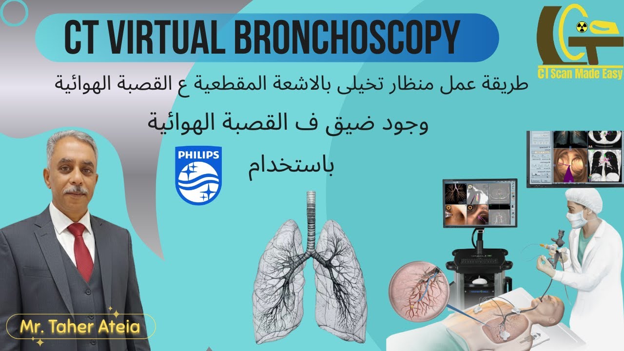 Ct Virtual Bronchoscopy (Tracheal Stenosis) by Philips Workstation