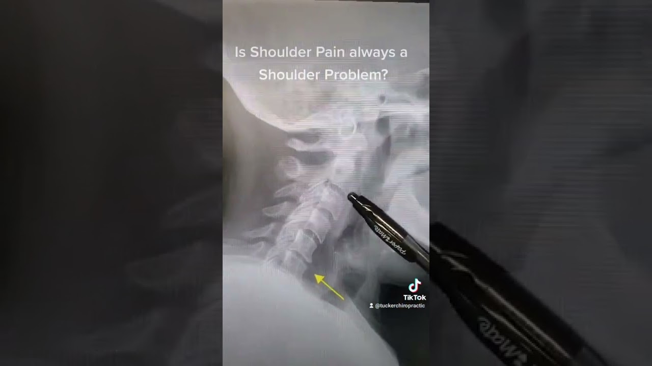 Neck Xray for Shoulder Pain?