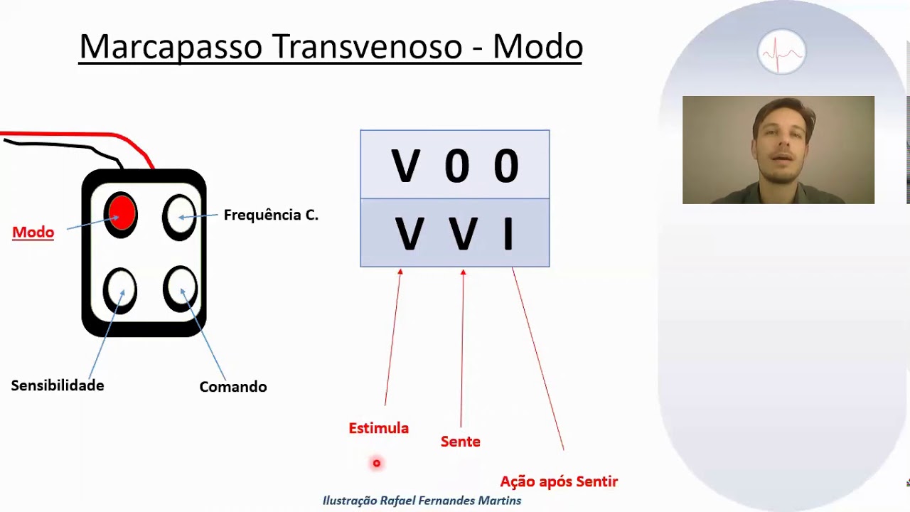 Passagem de Marcapasso transvenoso e ajustes