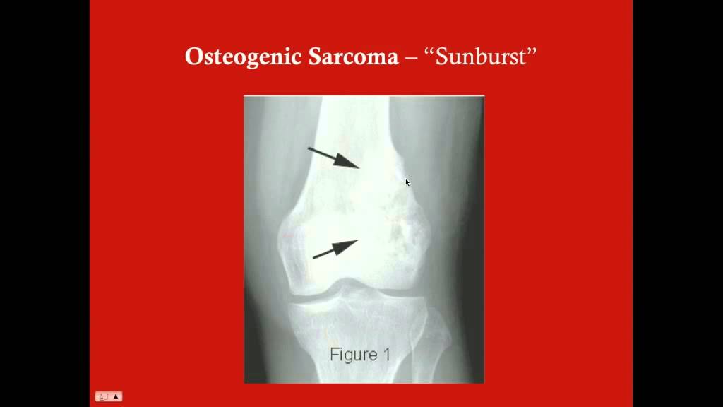 Orthopedic Tumors - CRASH! Medical Review Series