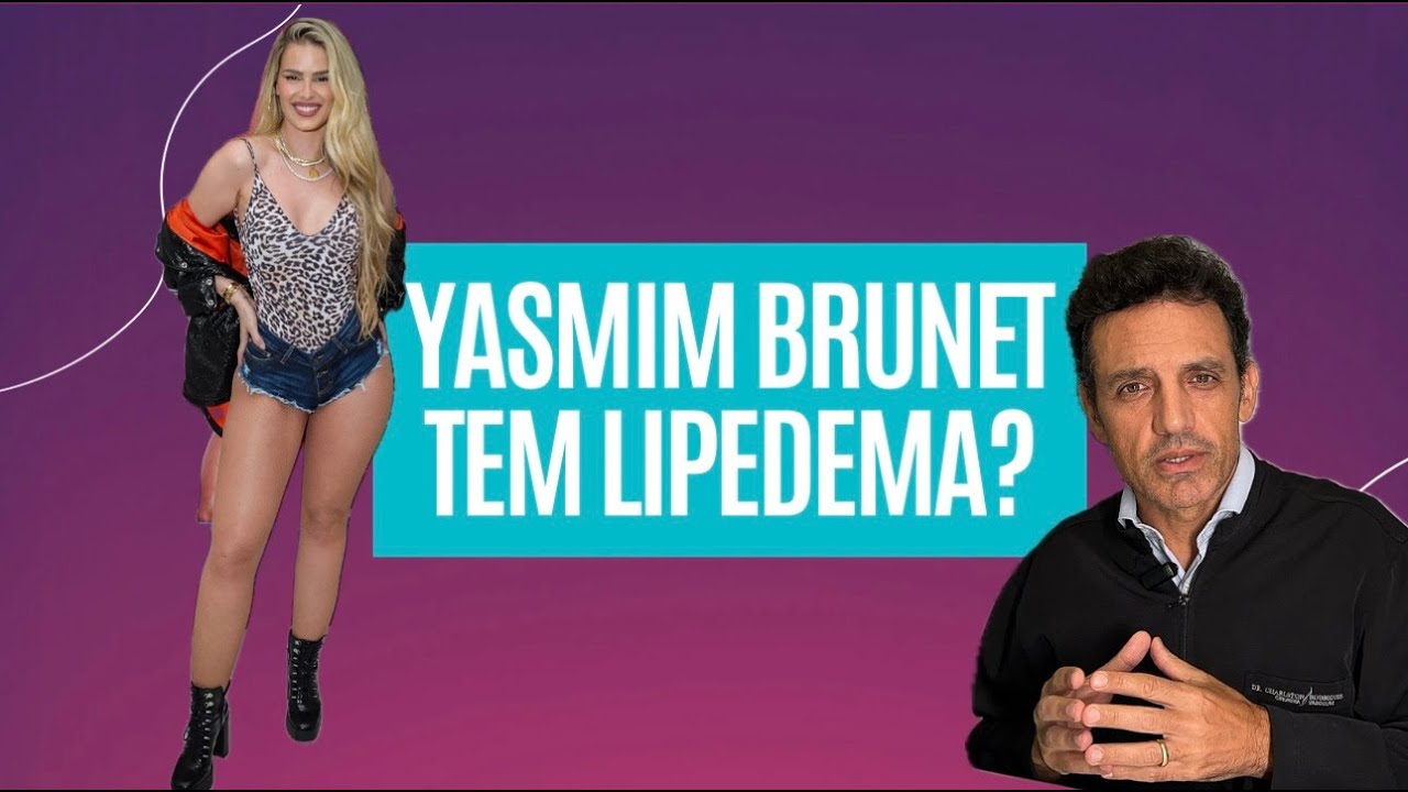 BBB 24: Yasmin Brunet Tem Lipedema? Saiba o que é a doença | Dr. Charlston Rodrigues