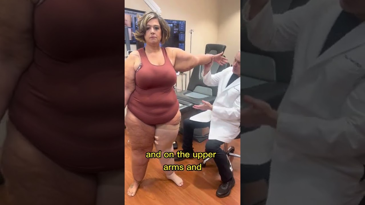 Dr Wright shows the signs of lipedema in the arms with a wrist cuff