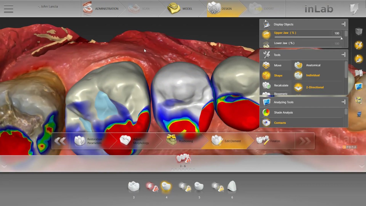 Step-By-Step Posterior Bridge Design Process