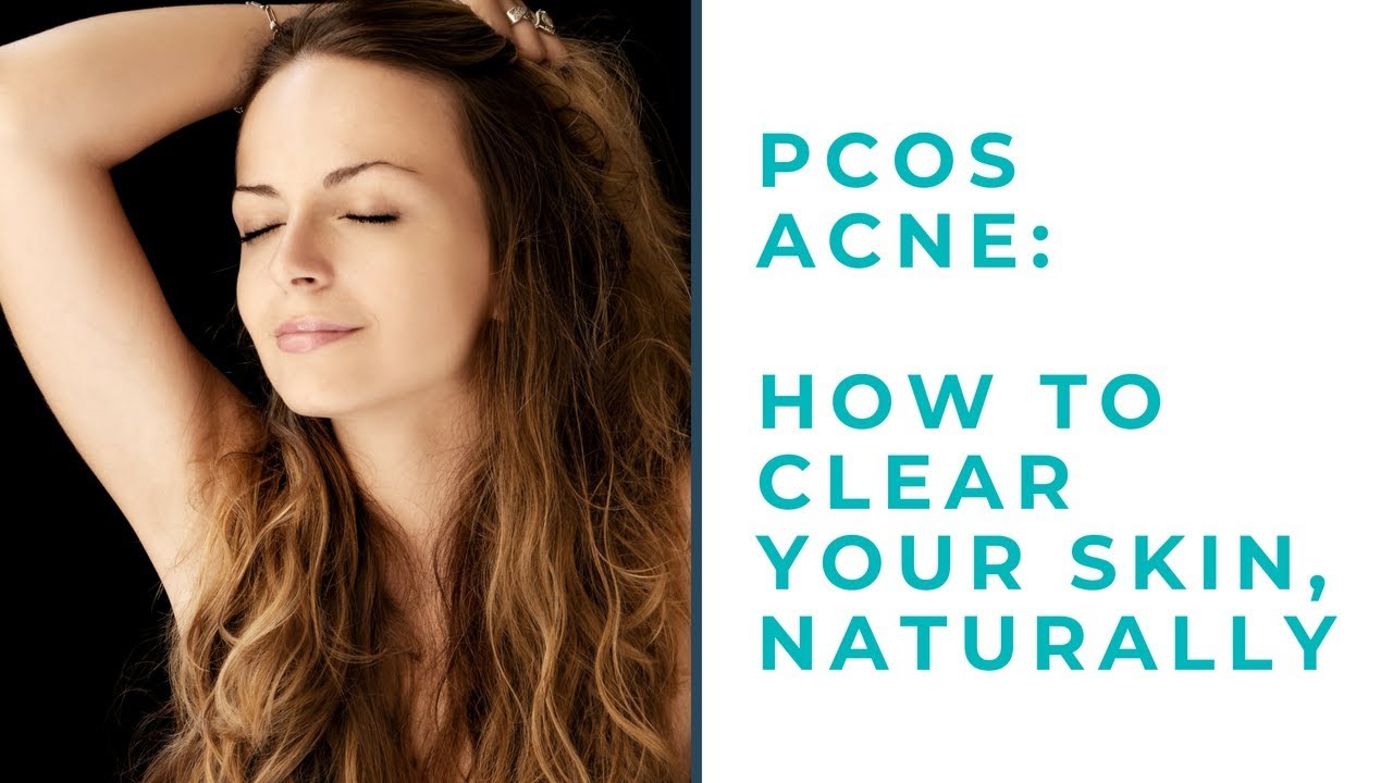 PCOS Acne: How To Clear Your Skin, Naturally