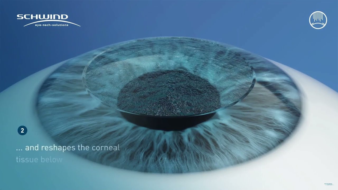 &iquest;C&oacute;mo es la cirug&iacute;a con Trans-PRK SmartSurfACE?
