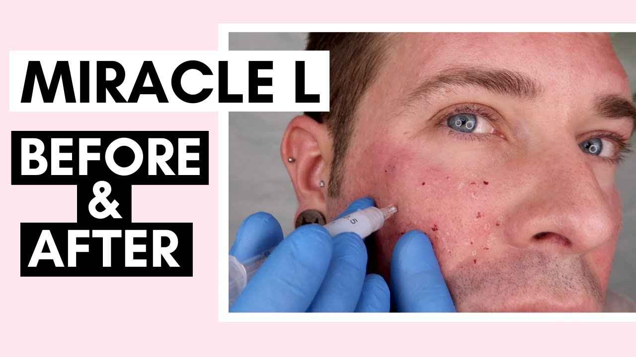 Miracle L Injections With 5-Pin Needle & Mesotherapy Ft. @Vanidiy