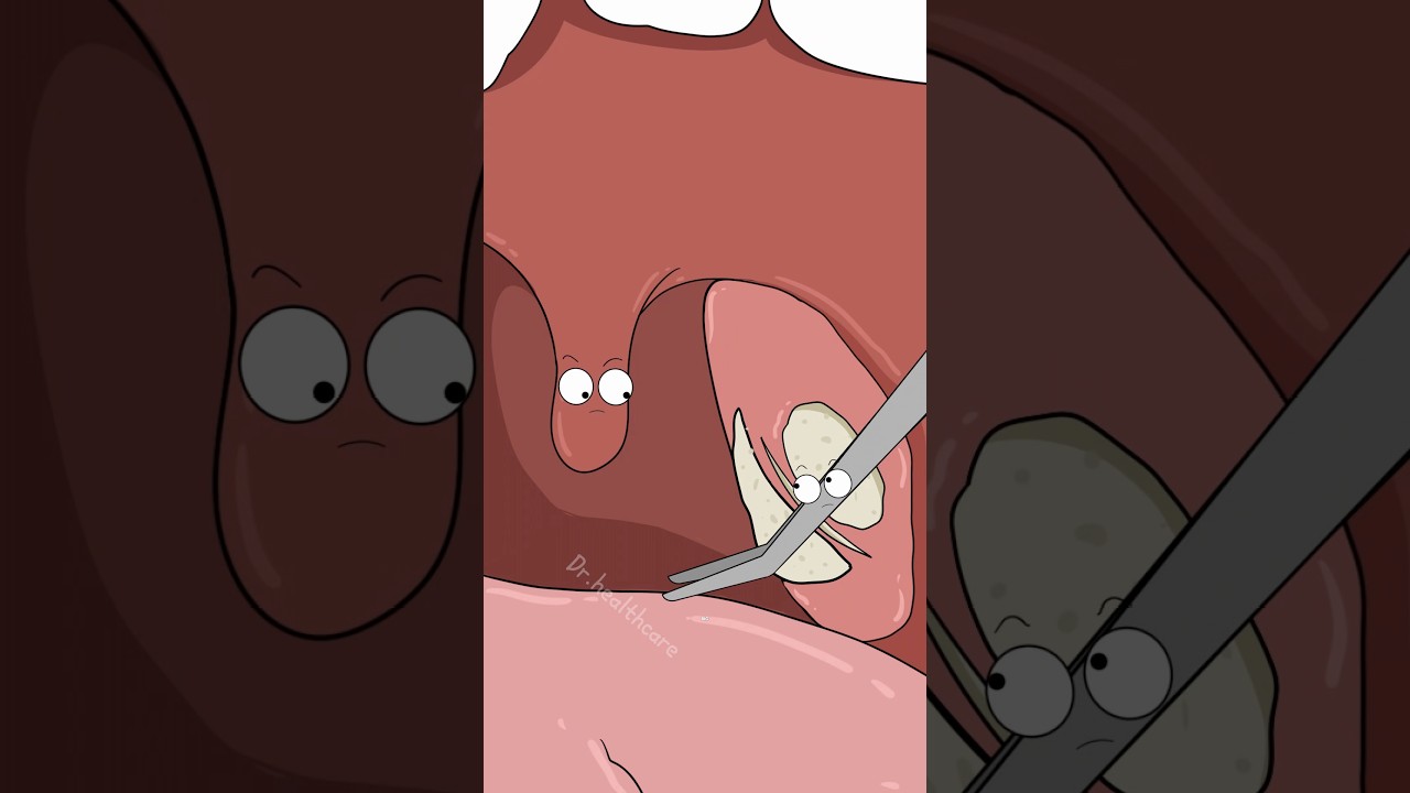 He Had Tonsil Stones, So They Removed His Tonsils
