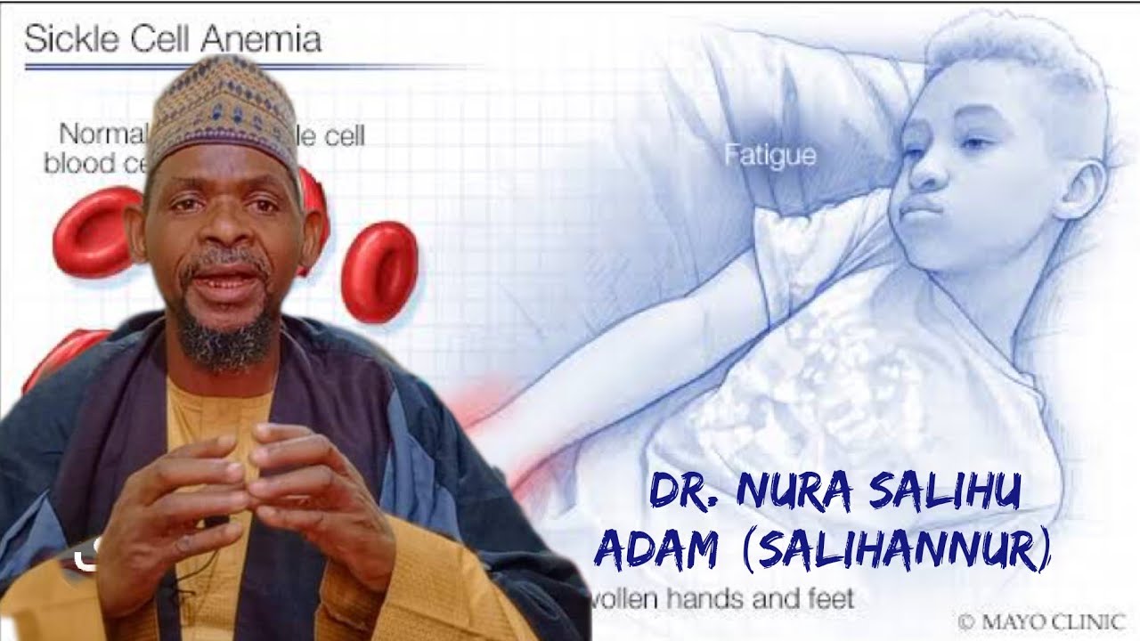 Dr. Salihannur) Bayani Akan Masu Sickle cells Da Yadda Zasu Magance Matsalar Da Izinin Allah