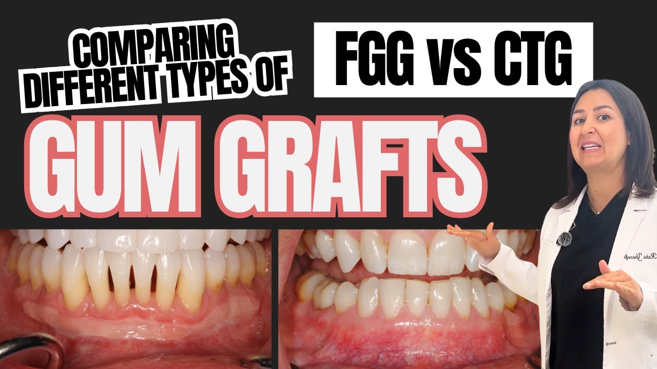 Different Types of Gum Grafts: FGG vs CTG. What's the Difference?  |   District Dental Surgery