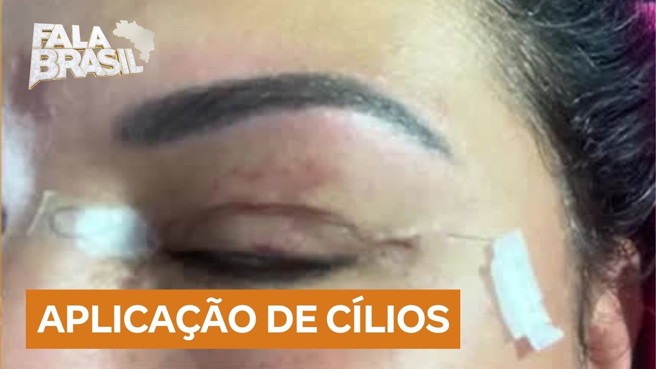 Aplicação de cílios postiços pode provocar alergia e inflamação nos olhos
