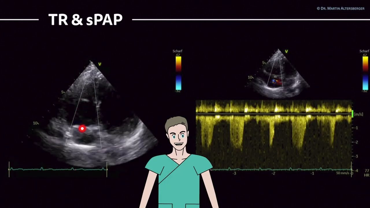 〖Echocardiography〗 PW Doppler MV, TAPSE, sPAP measured in the apical views 💖