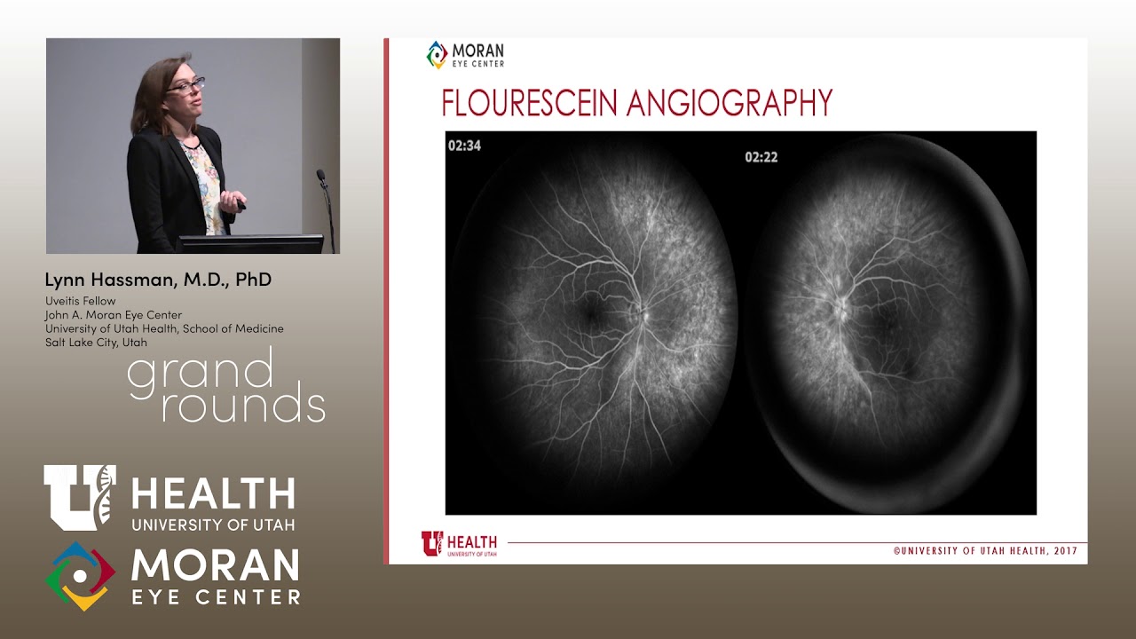 Update on Autoimmune Retinopathy