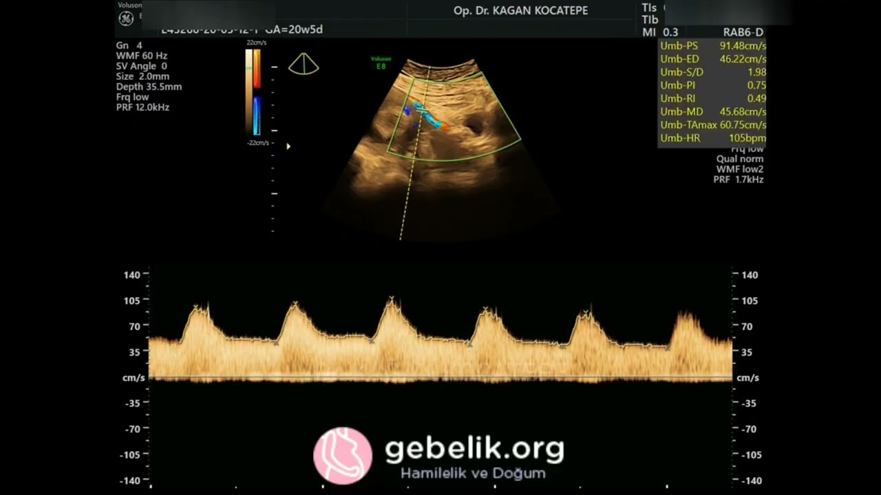 Gebeyim, renkli Doppler'de çentik ve direnç artışı saptandı, ileride preeklampsi gelişebilir dendi.