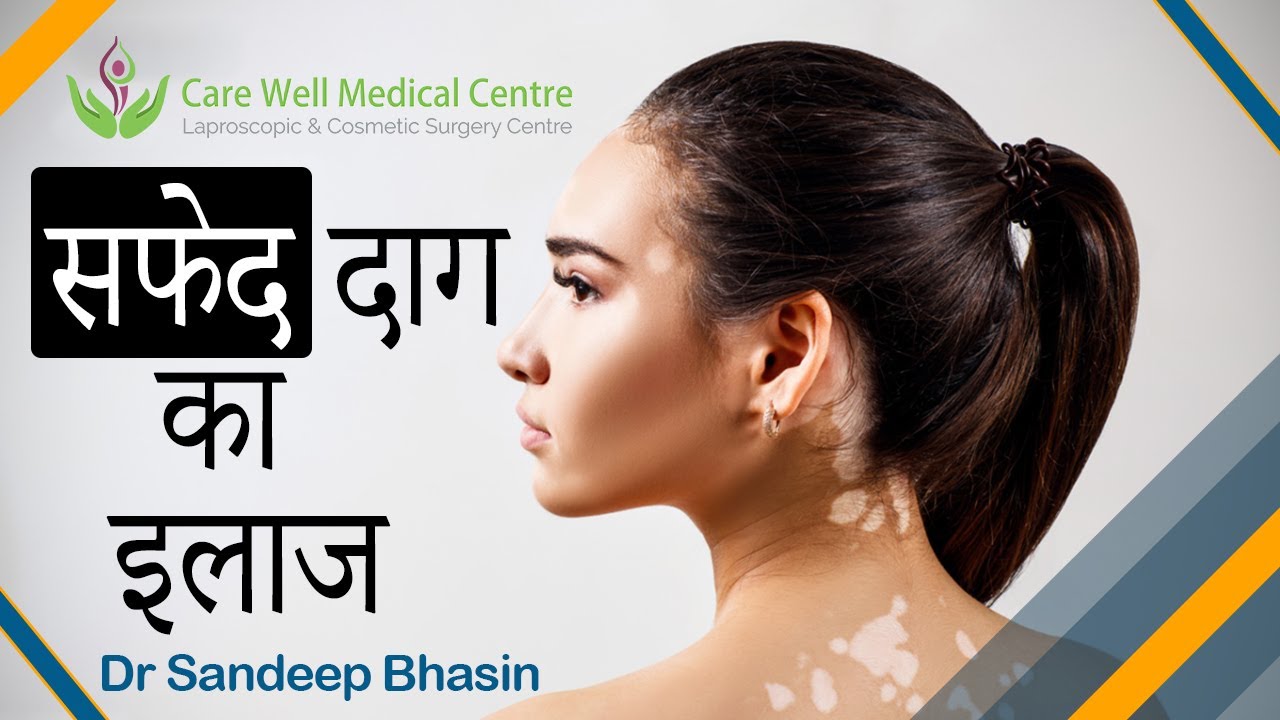 Excimer Laser Vitiligo Latest Treatment Know by Dr. Sandeep Bhasin | Care Well Medical Centre