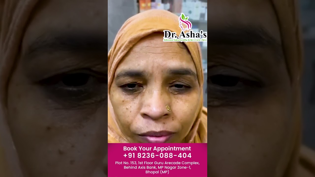 Dr Asha Shrivastava, MP Nagar, Zone-I, Bhopal  @dr.asha'sclinic #skincare #doctor