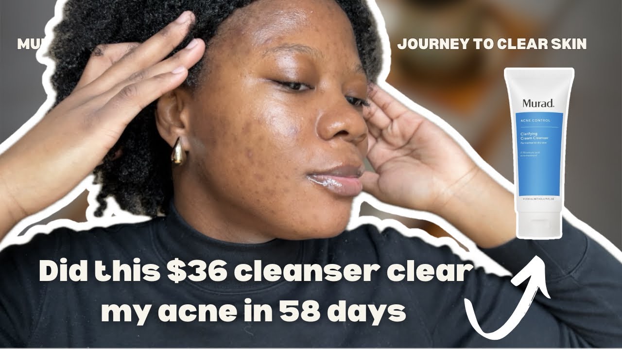 My honest review of the Murad Acne Control Clarifying Cleanser after 58 days (2 months)