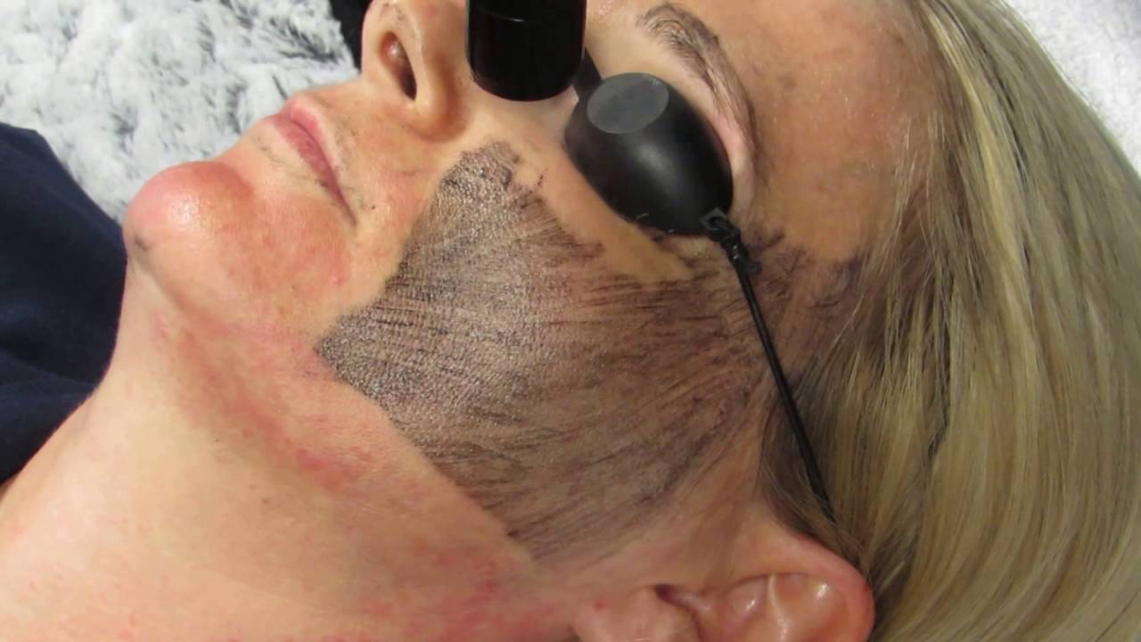 WPR Tried & Tested: Carbon Laser Facial Rejuvenation Procedure and Before After Photos