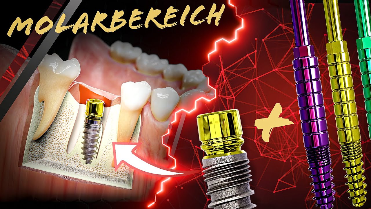 MIMI® 0 erklärt: Sofortimplantation im Molarenbereich mit CHAMPIONS (R)Evolution® Implantat