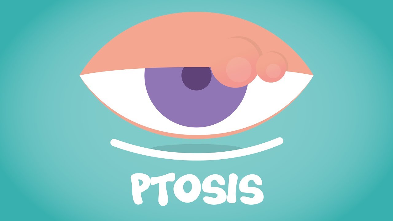 What is Ptosis?