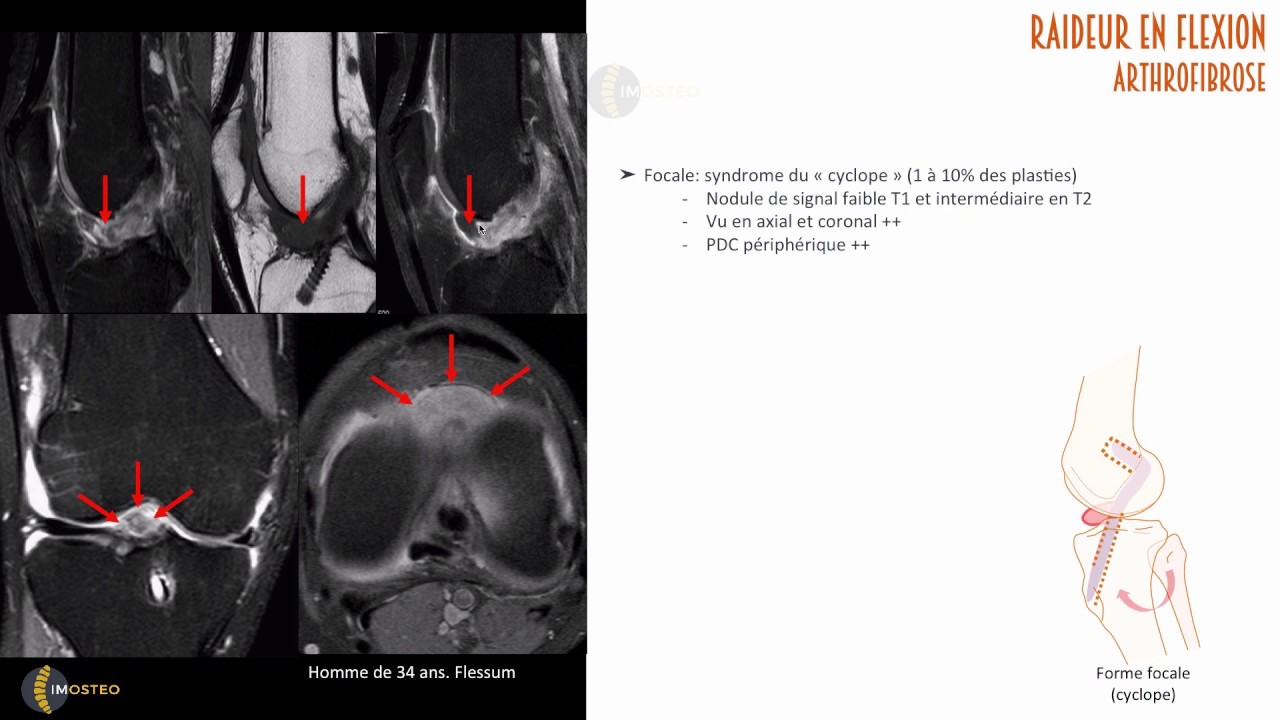 TUTORIEL IMOSTEO # 18 : Ligament croisé antérieur opéré- Complications fréquentes