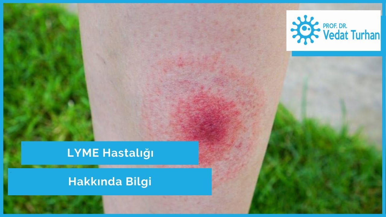 Lyme Hastalığı | Lyme Hastalığı Nedir | Lyme Hastalığı Hakkında Bilgi | Prof. Dr. Vedat TURHAN