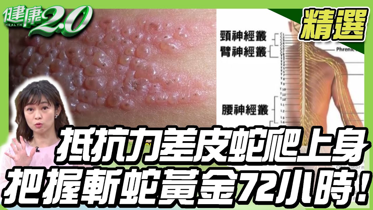 抵抗力差「皮蛇」爬上身！把握斬蛇黃金72小時！【健康2.0精選】