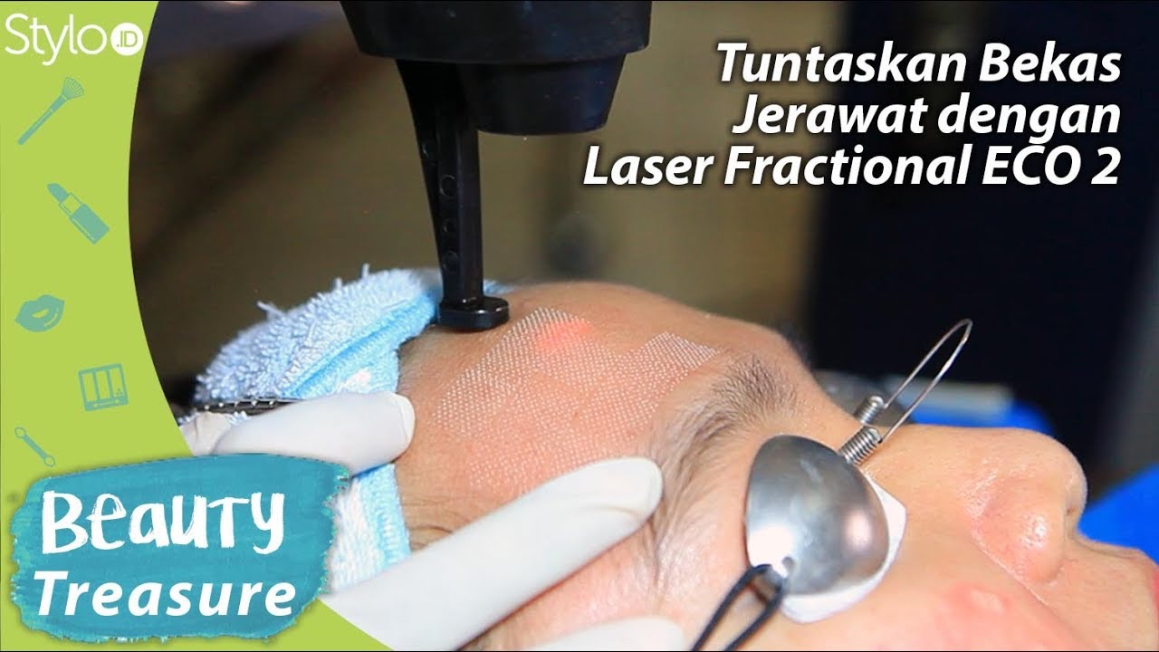 Atasi Bekas Jerawat dengan Laser Fractional ECO 2 | Klinik Estetika dr Affandi