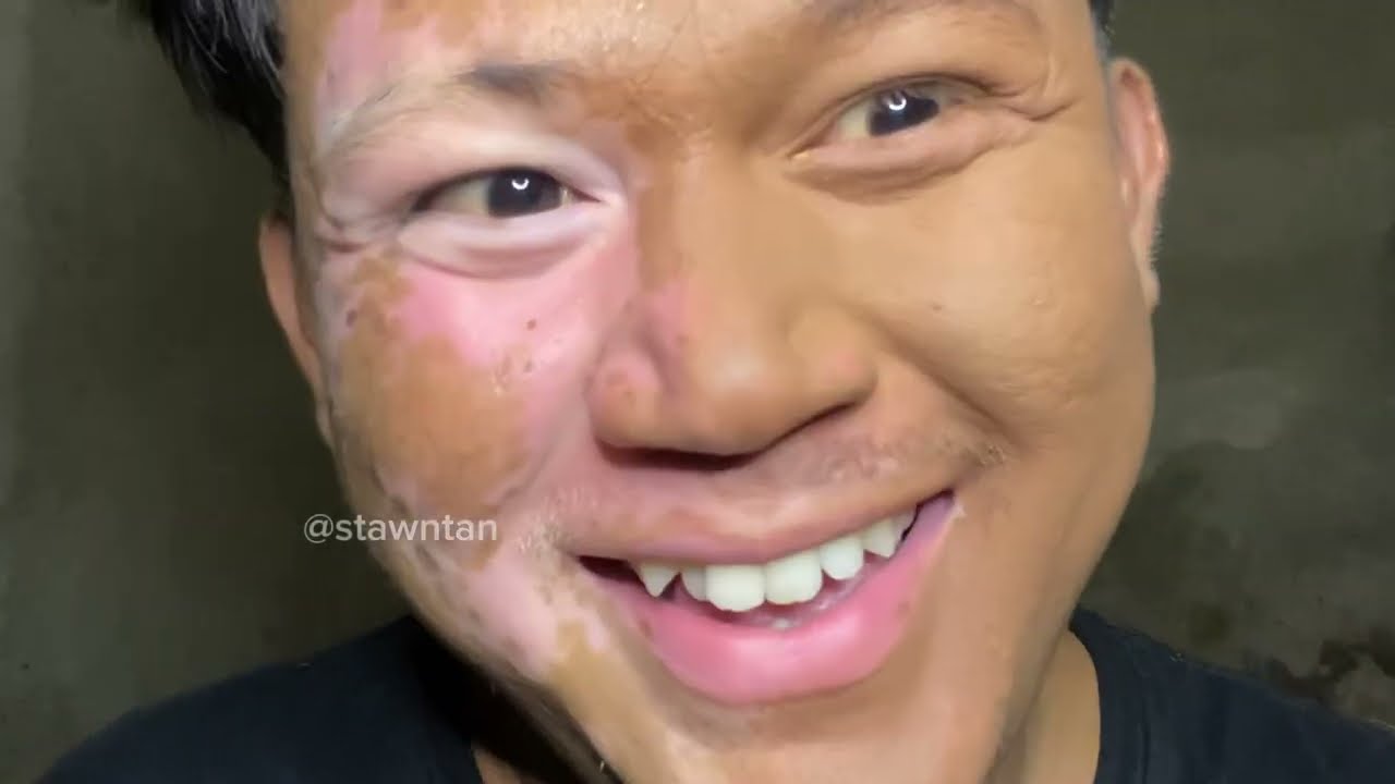 MAKE UP VITILIGO | MAKE UP UNTUK VITILIGO 2025