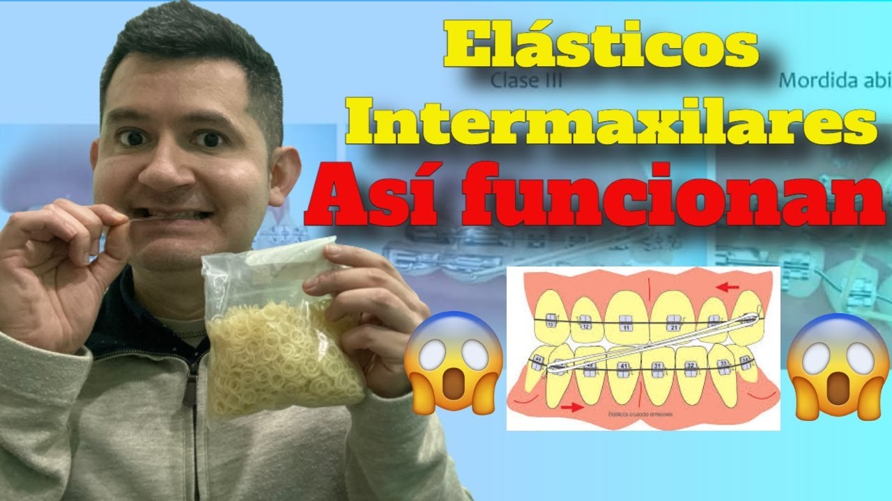 Ligas Elasticas Brackets | Dr. Josué Mejía