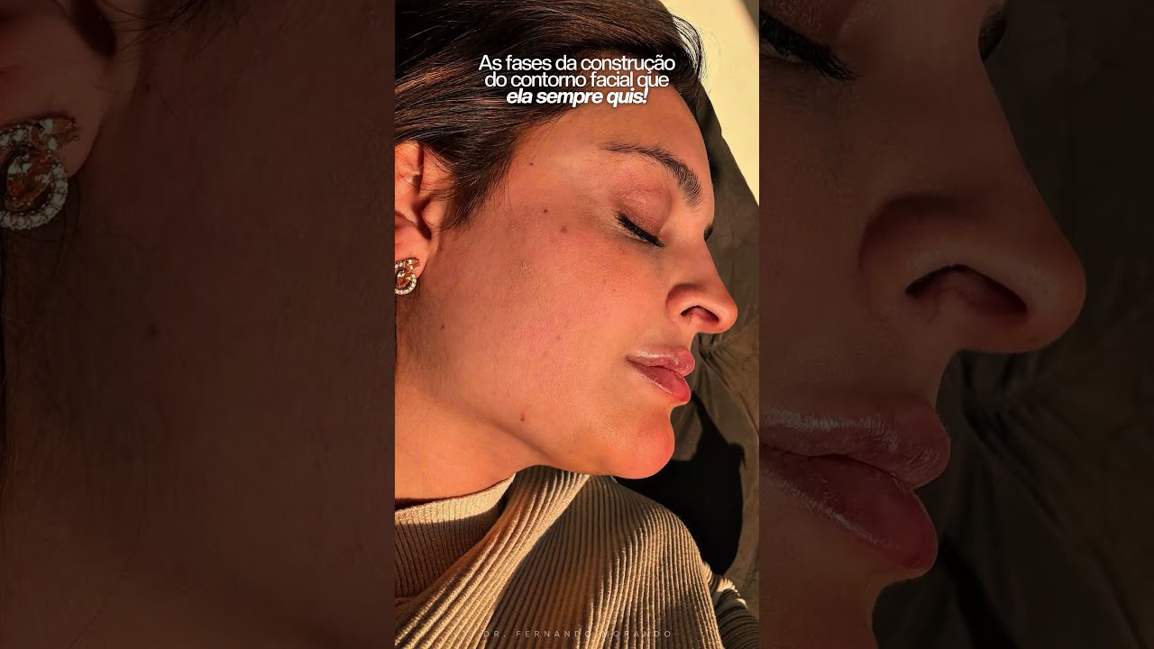 Lipo de Papada, Platismoplastia e Bichectomia: a Estratégia Cirúrgica por Trás do Contorno Facial